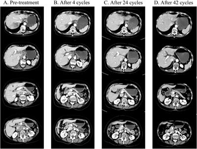 A case report: deep and durable response to low-dose lenvatinib and tislelizumab in an elderly patient with advanced intrahepatic cholangiocarcinoma